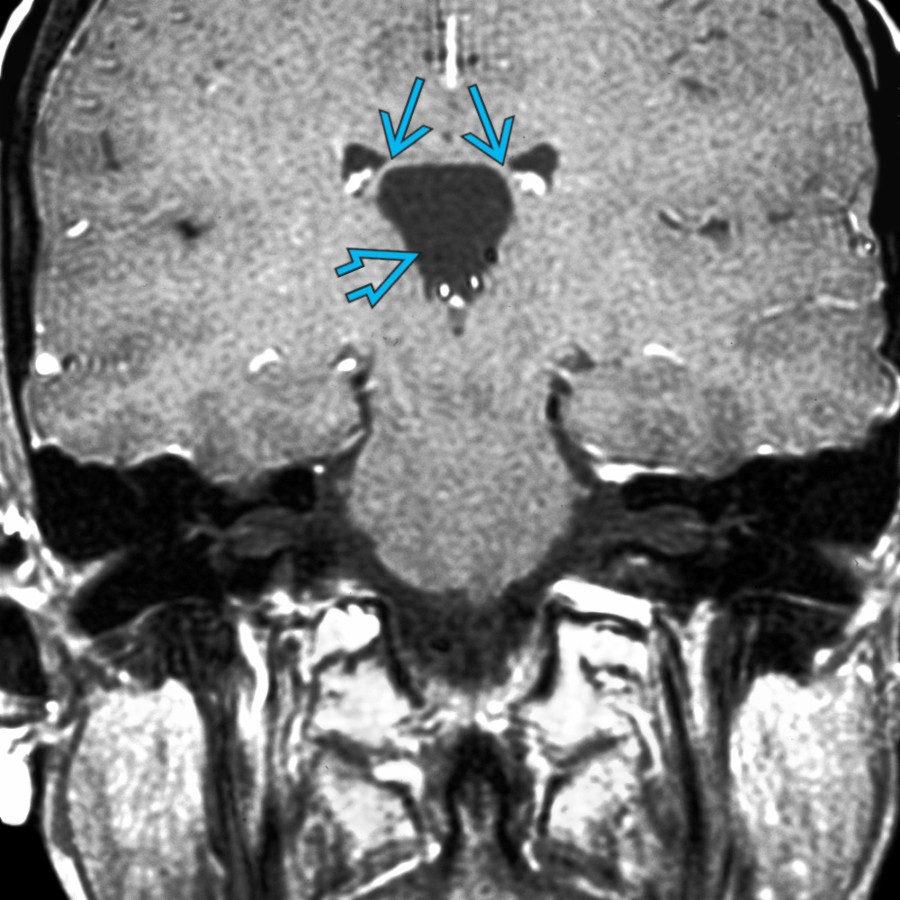 Coronal T1 C+ MR shows classic cavum velum interpositum
that spreads the fornices
apart.
