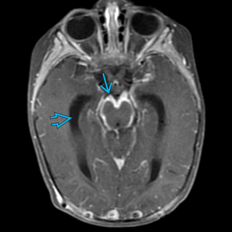 Axial T1 C+ FS MR in an 8-month-old with tuberculous meningitis shows extensive basilar leptomeningeal enhancement
& enlargement of the lateral ventricles
, resulting in macrocephaly. Granulomatous infections are more likely to result in hydrocephalus compared to other bacterial meningitis.