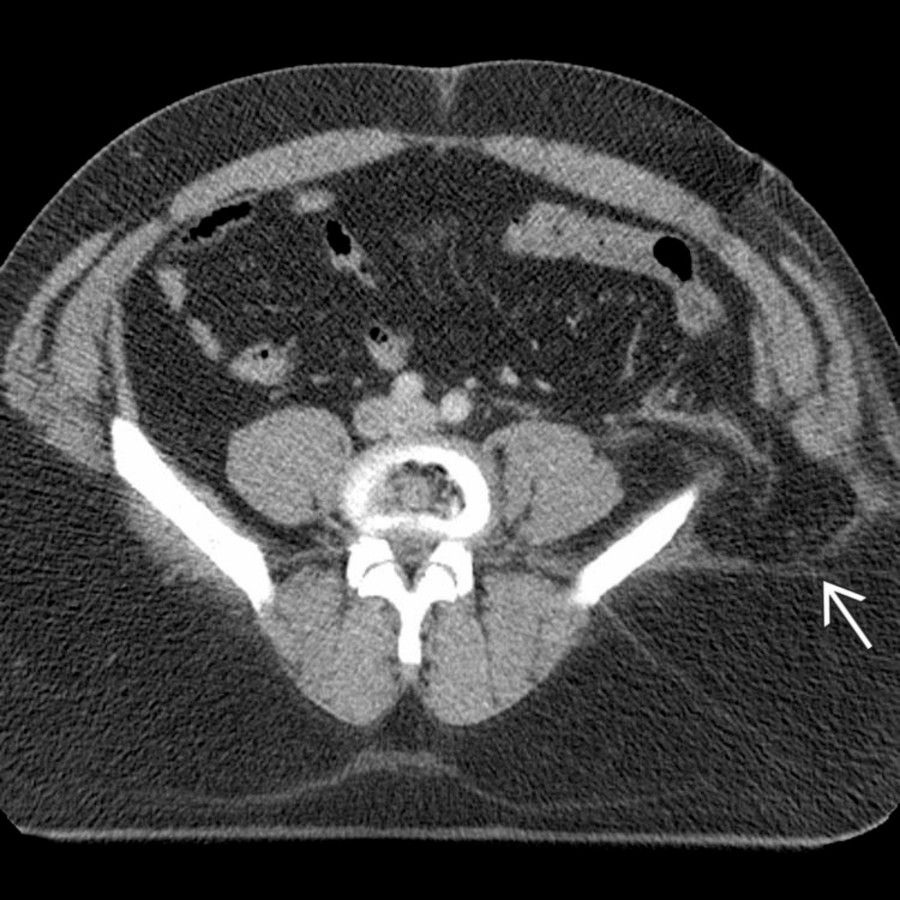 Axial CECT shows avulsion of the muscular and tendinous insertions of the abdominal wall muscles from the left iliac wing and thoracolumbar fascia with creation of a posttraumatic lumbar hernia
. Posttraumatic lumbar hernias are rare but much more likely to be associated with strangulation or incarceration.