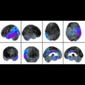 Stereotactic surface projections show marked asymmetric left-sided parietal
and posterior temporal
hypometabolism in this patient with clinical lvPPA.
