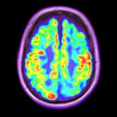 Axial fused FDG PET/MR shows L > R frontal hypometabolism
as well as left parietal hypometabolism
in a 51-year-old woman with severe frontal dysexecutive features.