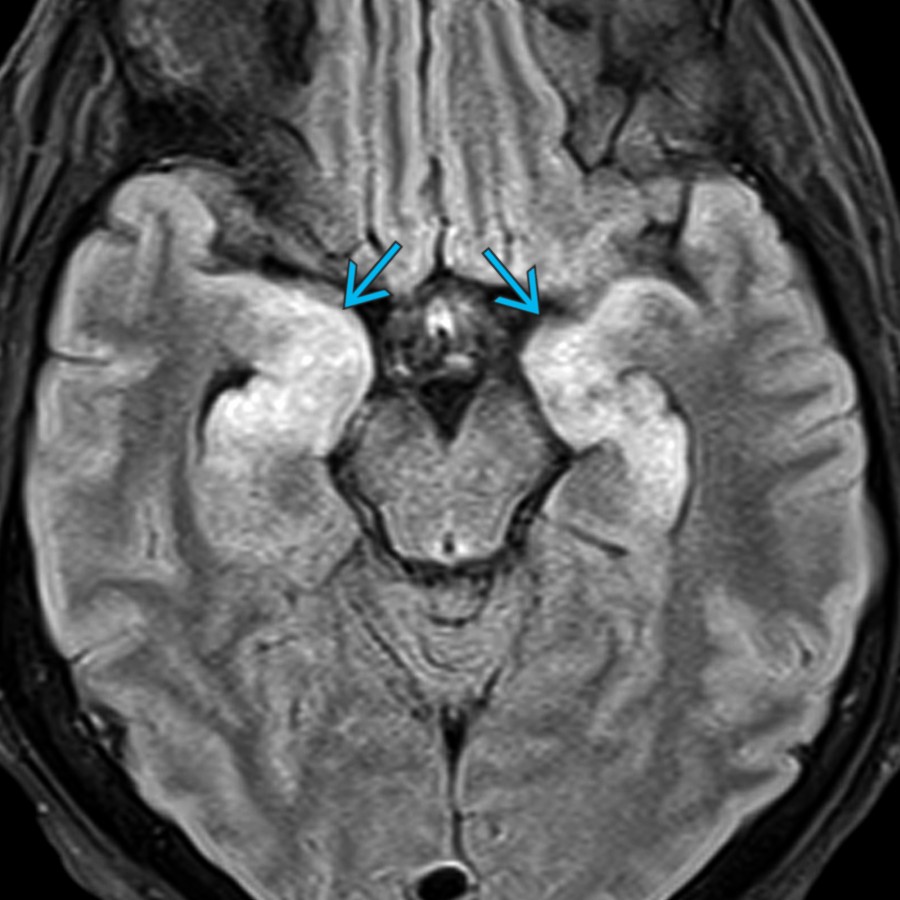 Axial FLAIR MR shows abnormal hyperintensity in the bilateral medial temporal lobes
, characteristic of limbic encephalitis (LE), the most common paraneoplastic syndrome. Bilateral involvement is typical of limbic encephalitis.