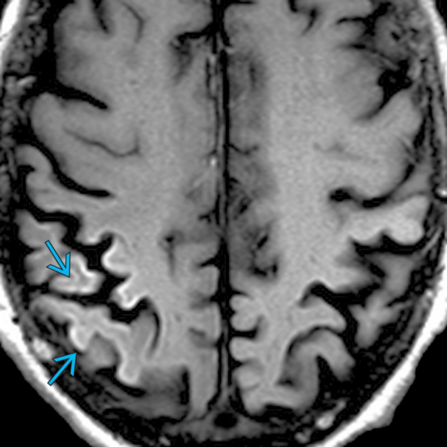 Axial T1 MR in the same patient on day 25 shows cortical T1 hyperintensity
due to laminar necrosis. Although SE-related imaging abnormalities may completely reverse following cessation of seizures, prolonged seizure activity can result in permanent abnormalities, as seen in this case.
