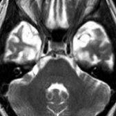 Axial T2WI MR in a patient with FTD demonstrates marked volume loss as well as associated hyperintense signal within bilateral temporal lobes.