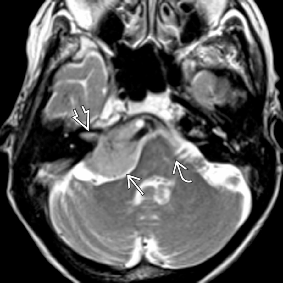 Axial T2 MR reveals a dural-based CPA mass with IAC penetration
with a "CSF-vascular cleft"
between it and the adjacent brachium pontis-pons. Note the normal root exit zone of the contralateral left CNVII
.