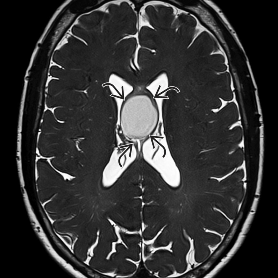 Axial thin-section T2-space MR shows the fornices
draped around the mass.