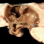 Sagittal gross pathology shows classic adamantinomatous craniopharyngioma with mixed solid, cystic components. The classic machine or "crankcase oil"
is present. Note the intrasellar extension
. (Courtesy R. Hewlett, MD.)