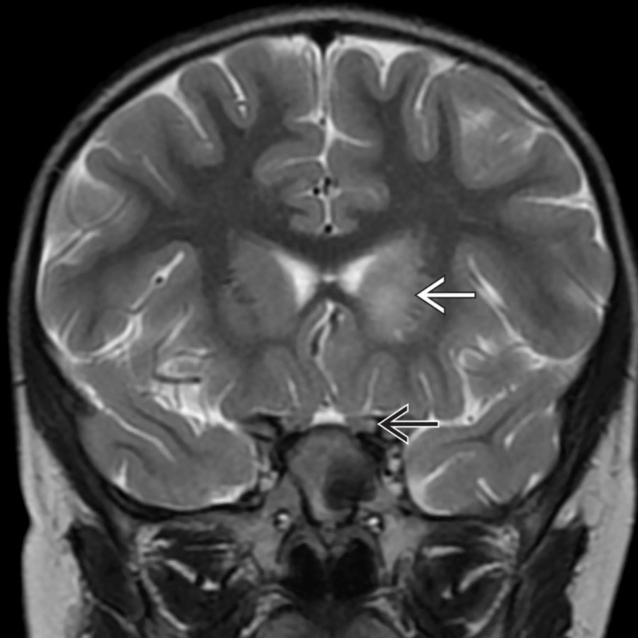 Coronal T2 MR through the frontal lobes of a pediatric patient with encephalopathy, optic neuritis, and confirmed MOGAD reveals abnormal hyperintensity within the left basal ganglia
as well as mild hyperintensity in the left cisternal optic nerve
.