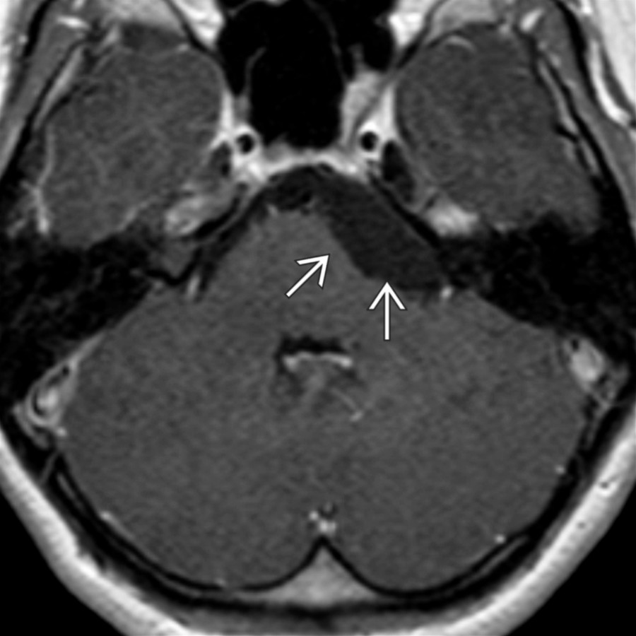 Axial T1 C+ MR in a teenager with occipital headaches shows an extraaxial hypointense mass
, similar in signal intensity to intraventricular CSF, compressing the pons. Differential diagnosis would include arachnoid cyst or dermoid/epidermoid cyst.