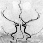 Coronal MRA in a patient with ectopic posterior pituitary bright spot shows marked medial deviation of the juxtasellar/supraclinoid internal carotid arteries. Note right deviated internal carotid artery
and dominant left anterior cerebral artery (ACA).