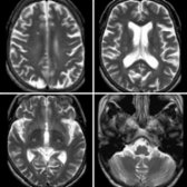 Axial T2 MR in a patient with ALS shows hyperintensity along the course of the CST
bilaterally. Important to note that CST is typically slightly hyperintense on T2 especially at 3.0 T.