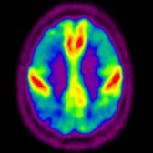 Axial F-18 FDG PET in a patient with late-stage AD demonstrates severely reduced metabolism in the posterior parietal
and frontal
cortices. Importantly, there is characteristic sparing of the sensorimotor region
.