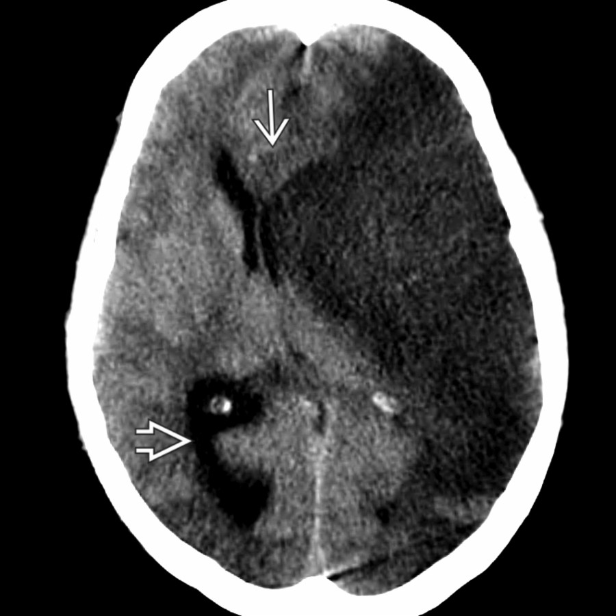Axial NECT shows complete loss of the left middle cerebral artery gray-white distinction with cytotoxic edema and left-to-right subfalcine herniation
. Note the compression of the ipsilateral left lateral ventricle and enlargement of the right lateral ventricle
from entrapment.