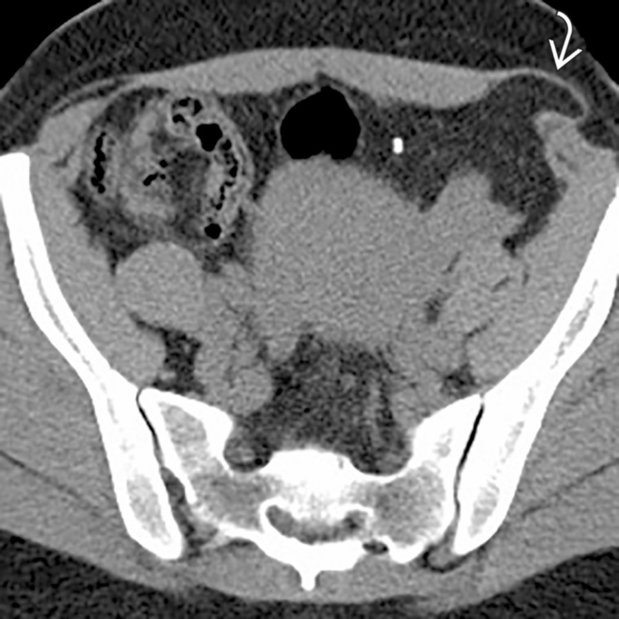 Axial NECT demonstrates a small Spigelian hernia in the left lower quadrant, inferior and lateral to the umbilicus. Note the layer of the external oblique muscle
overlying the hernia sac.