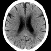 Axial NECT in an 85-year-old patient without cognitive impairment shows wide sulci & lateral ventricles, as well as moderate periventricular hypodense white matter.