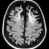 Axial FLAIR MR shows frontal lobe volume loss as well as associated hyperintense signal in white matter.