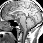Sagittal T1WI MR shows an elongated basilar artery with a slow-flow, thickened wall
. The apex of the tortuous basilar artery indents the hypothalamus, 3rd ventricle
.