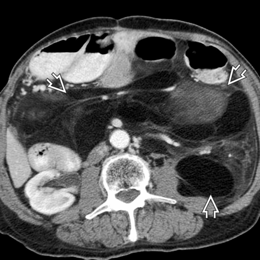 Axial CECT shows a huge retroperitoneal mass
abutting the psoas compartment. Some portions of the mass have well-differentiated fatty components, characteristic of liposarcoma.