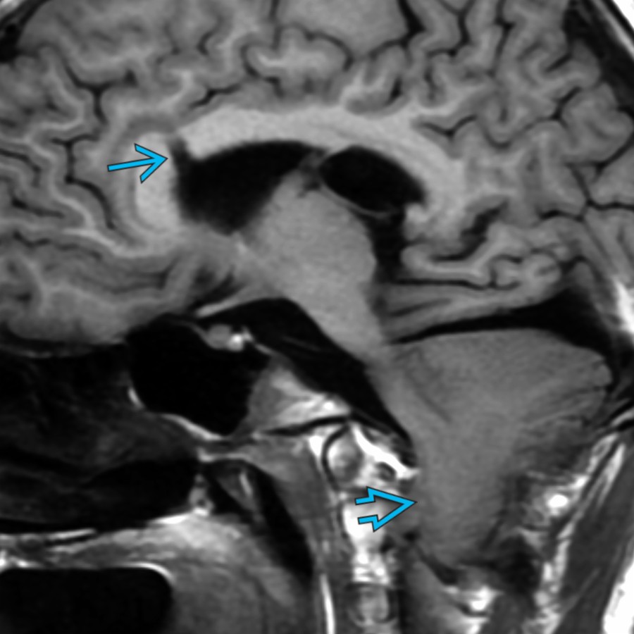 Paramidline sagittal T1 MR in a 12 year old with Chiari 2 malformation shows a ventricular shunt catheter tract
in the anterior body of the CC. Note the caudal migration of the cerebellum & brainstem
, consistent with Chiari 2.