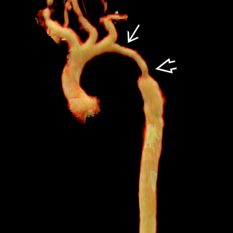 Sagittal oblique CTA cinematic rendering shows a hypoplastic distal aortic arch
involving the isthmus and proximal DA
.
