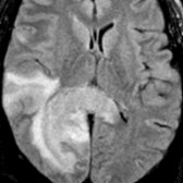 Axial FLAIR MR in a patient with AQP4-IgG (+) NMOSD demonstrates large confluent lesions in the right temporal and occipital regions
with involvement of the splenium
of the corpus callosum.