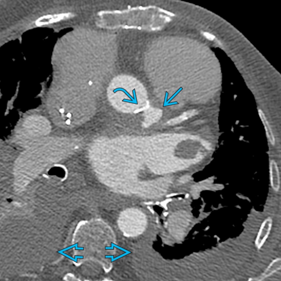 Axial CECT of the chest in a patient with PAU at the proximal ascending thoracic aorta shows an outpouching extending beyond the aortic wall
, adjacent atherosclerosis
, and bilateral pleural effusions
.