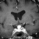 Coronal T1 C+ MR shows an enlarged, uniformly enhancing infundibulum in a peripartum woman with visual complaints and pituitary dysfunction. These are classic symptoms and findings of LH.