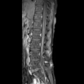 Sagittal T1 C+ FS MR of the lumbar spine in a patient with GBS shows CE nerve root enhancement, more intense in ventral
than dorsal
CE. Also note enhancement of the pial surface of the distal cord/conus
. GBS is an immune-mediated peripheral nerves and nerve roots disorder, usually triggered by infections.