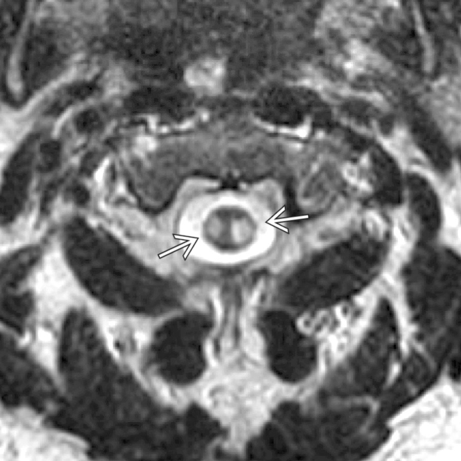 Axial T2 MR shows focal MS plaques as T2 hyperintensity within both the right & left lateral aspects of the cervical cord
.