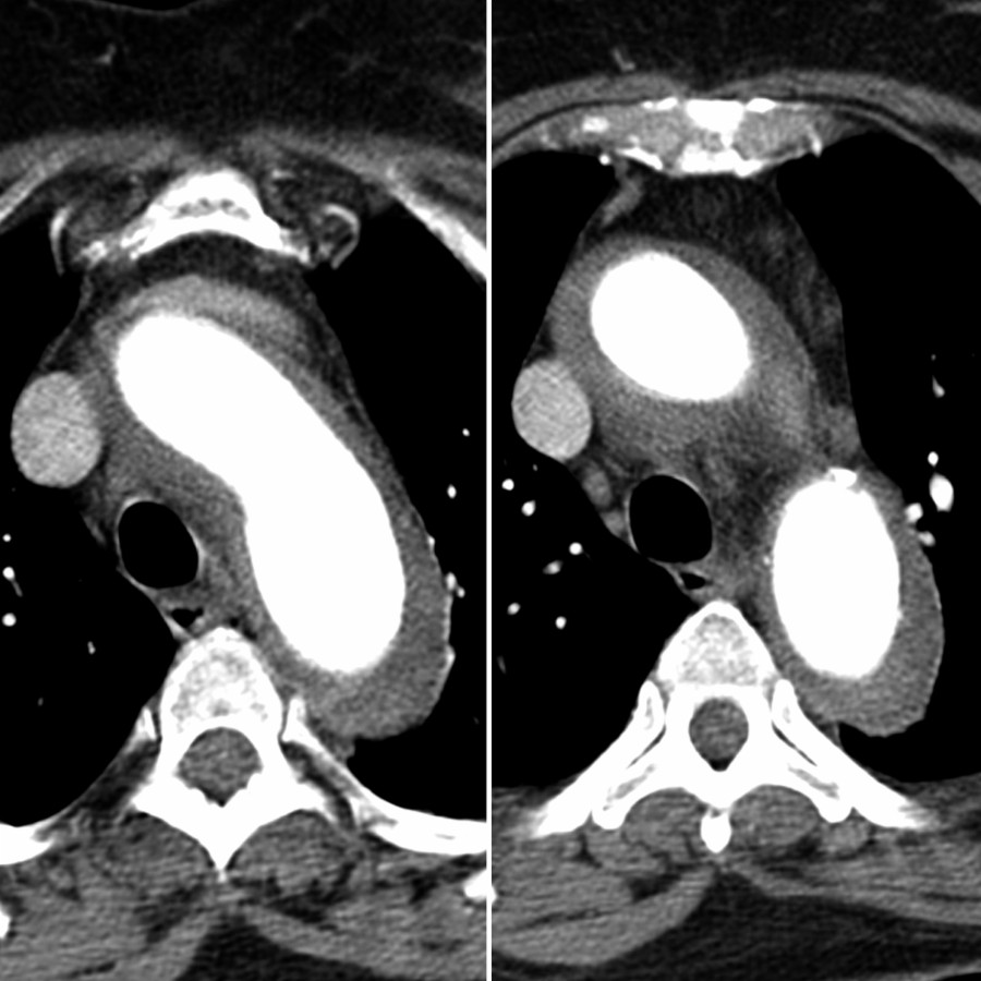 Axial chest CTA in the same patient shows concentric thickening of the thoracic aorta, which is a common finding in patients with GCA but is indistinguishable from Takayasu arteritis. GCA is more common in patients > 50 years old. Concomitant NECT is recommended to help differentiate from intramural hematoma. (Courtesy C. S. Restrepo, MD.)