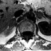 Axial in-phase T1 MR shows small, bilateral adrenal masses
.