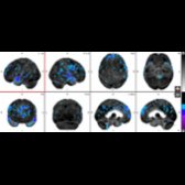 Surface projection in the same patient corroborates mild regional hypometabolism within the medial frontal lobes
and the bilateral temporal lobes
with preservation of the precuneus. This is suggestive of early FTD.
