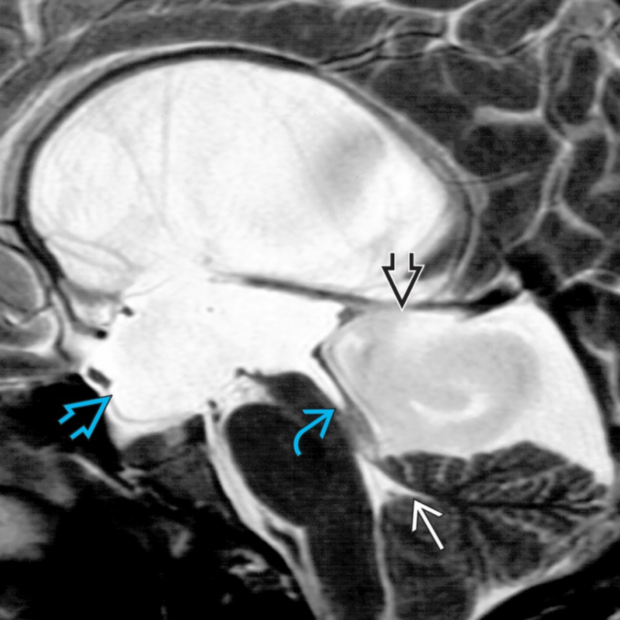 Sagittal T2WI MR shows massively enlarged 3rd
and lateral ventricles and an enlarged, funnel-shaped aqueduct
related to aqueductal stenosis in this child. There is also a medial atrial diverticulum
compressing the 4th ventricle
.