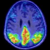 Axial fused tau PET/MR shows parietal
and precuneus
cortical binding to neurofibrillary tangles in this patient with late AD.