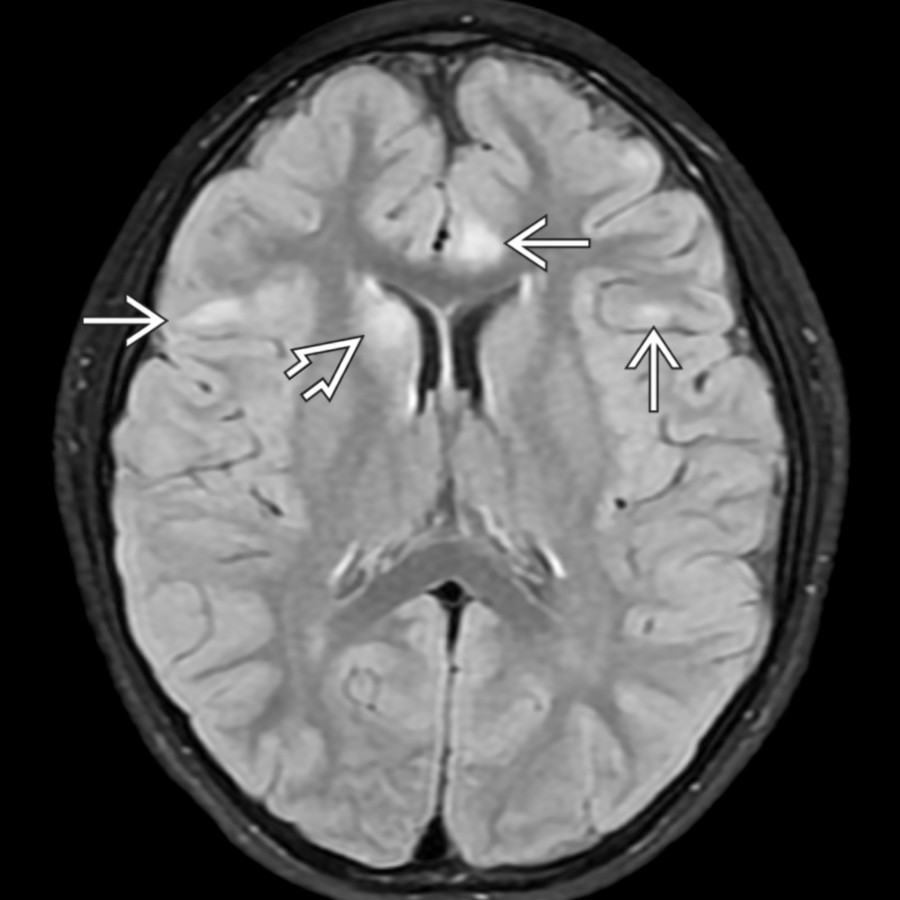 Axial FLAIR MR in a 7-year-old patient with MOGAD reveals subcortical white matter
and deep nuclear gray matter
involvement. This is a fairly typical appearance for MOGAD MR abnormalities.