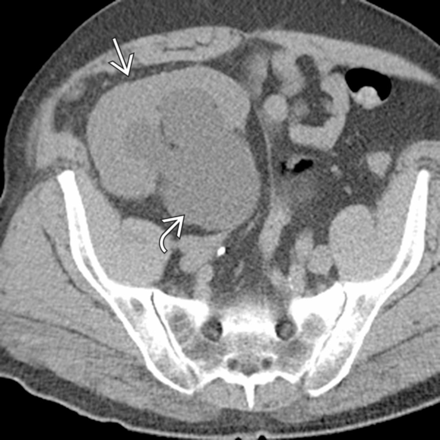 Axial NECT demonstrates a right lower quadrant transplant kidney
with marked hydronephrosis
.
