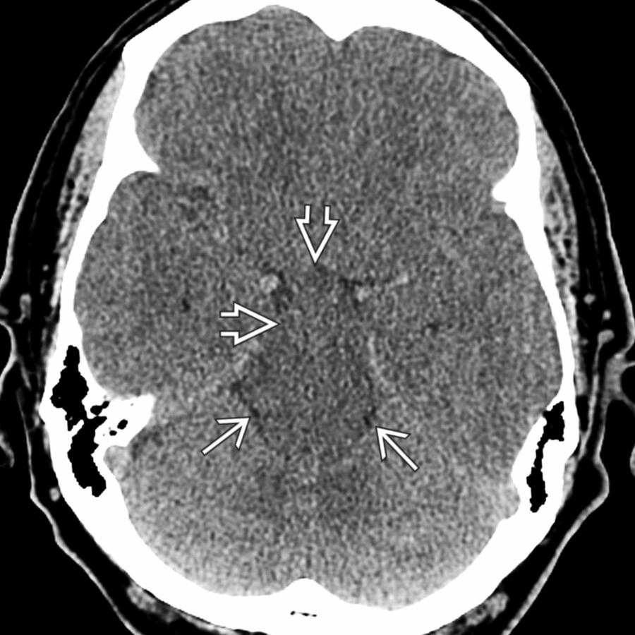 More cephalad NECT in the same patient shows effacement of all basal cisterns, especially the suprasellar cistern
. The midbrain appears "fat"
. The imaging findings are suggestive of IH.