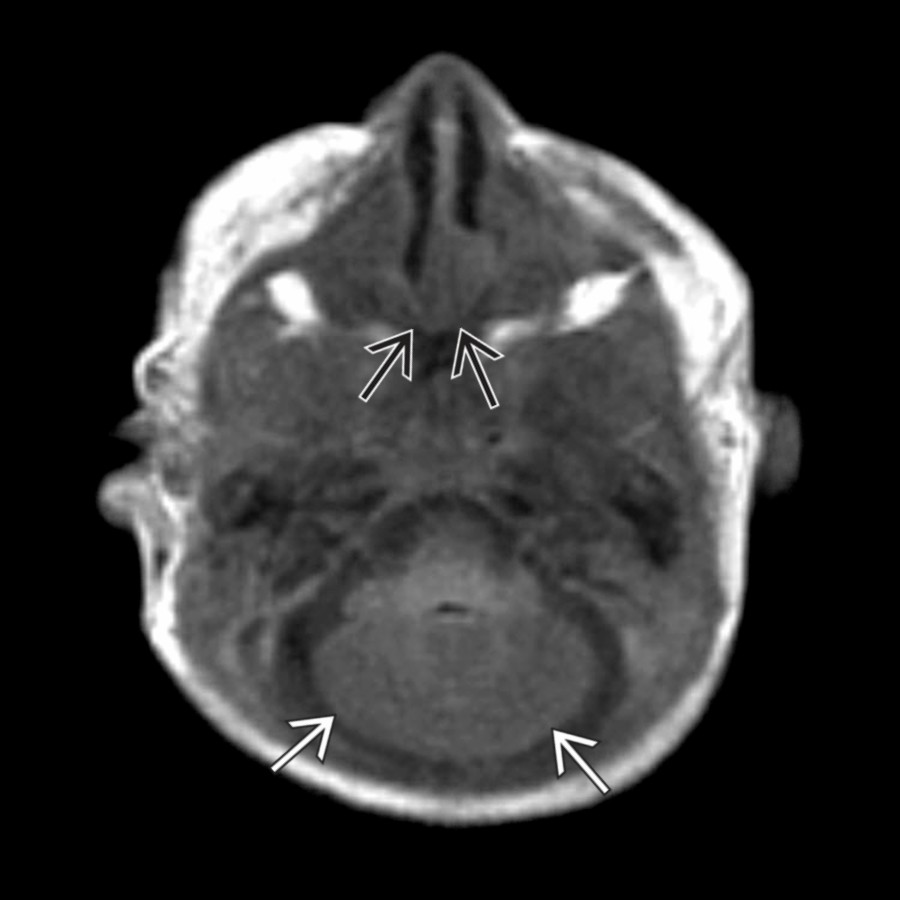 Axial T1WI MR in the same patient demonstrates rhombencephalosynapsis
and bilateral choanal atresia
. Other anomalies in this patient included bilateral microphthalmia and tracheoesophageal fistula. This patient had a partial deletion of chromosome 3q and SOX2 gene mutation.