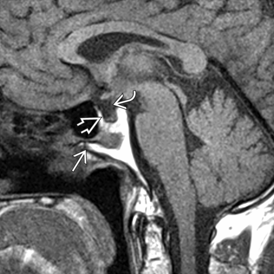 Sagittal T1 MR in a patient with hypopituitarism following transsphenoidal hypophysectomy
shows an empty sella
and a very thin, attenuated infundibular stalk
.