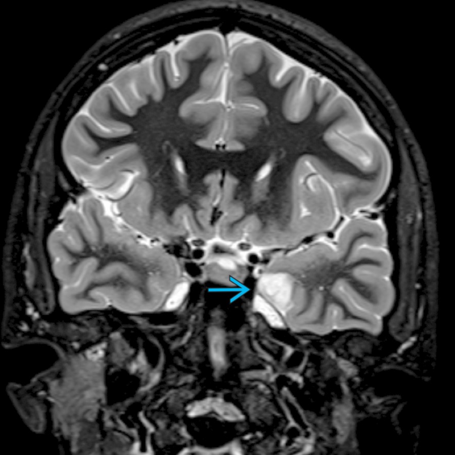 Coronal T2* MR in a 20-year-old woman with focal seizures shows a cortically based T2-hyperintense lesion
centered in the left parahippocampal gyrus, biopsy-proven DNET.