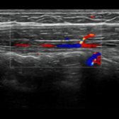 Longitudinal color Doppler ultrasound shows a perforating branch
of the deep inferior epigastric artery
extending into the rectus muscle
. These perforators are important for breast reconstruction with abdominal wall flaps.