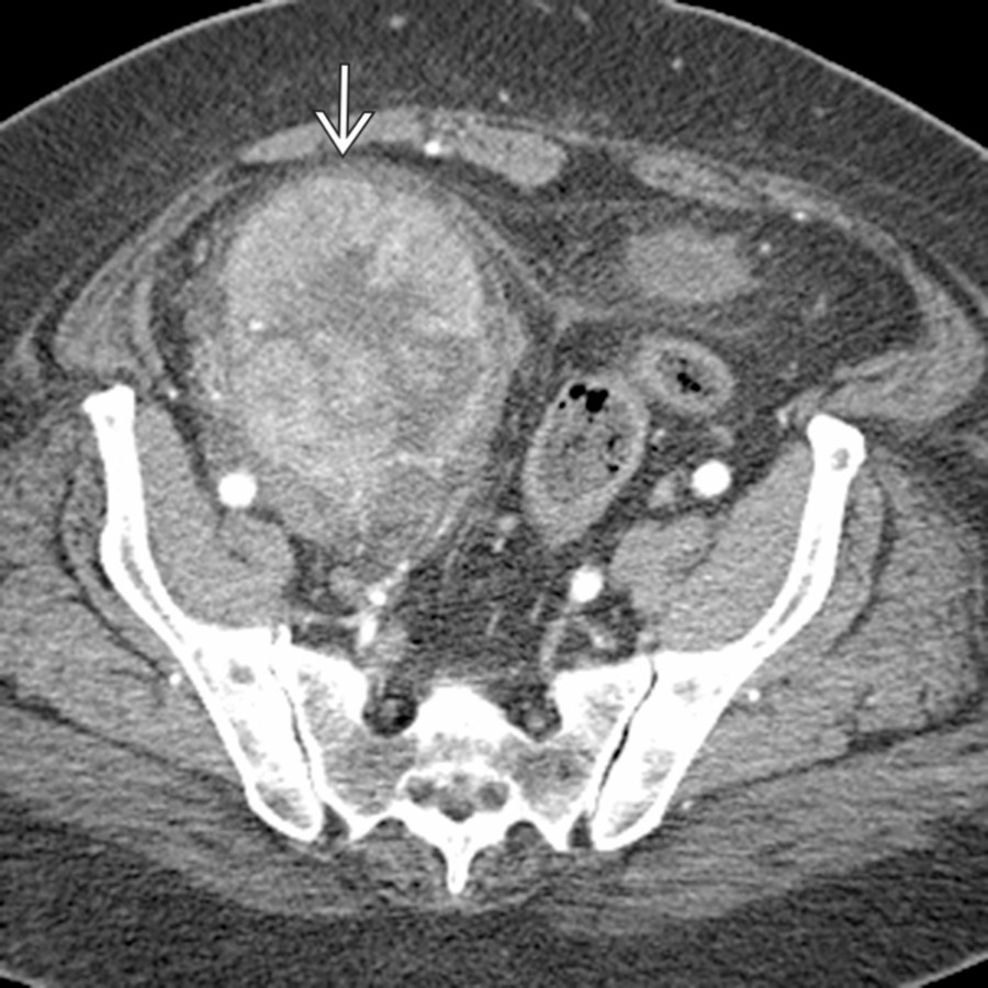 Axial CECT in the same patient demonstrates a large avidly enhancing mass
in the right lower quadrant. This was a patient with familial adenomatous polyposis (FAP), and both of these lesions were found to represent desmoid tumors.