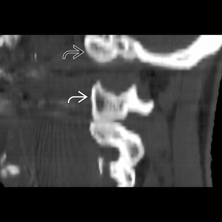 Sagittal bone CT shows occipital condyle
widely separated from lateral mass of C1
, indicating longitudinal atlantooccipital dislocation. Dislocation may also be anterior or posterior in direction.