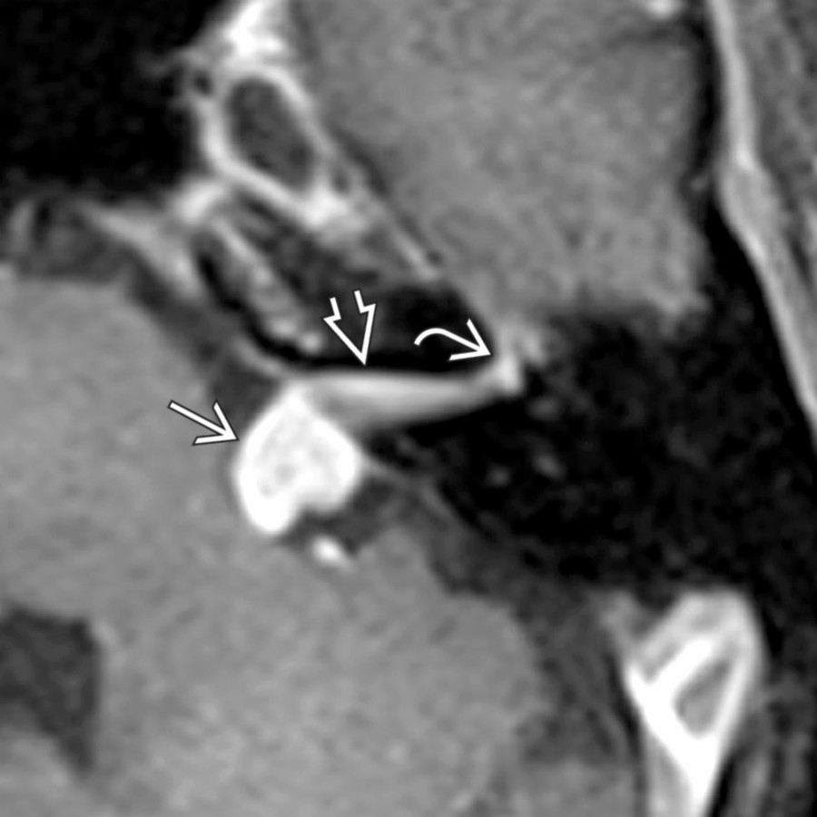Axial T1 C+ FS MR in a patient with unilateral sensorineural hearing loss shows FNS with CPA
& IAC
components. Note the labyrinthine segment facial nerve tail
, which differentiates FNS from vestibular schwannoma.