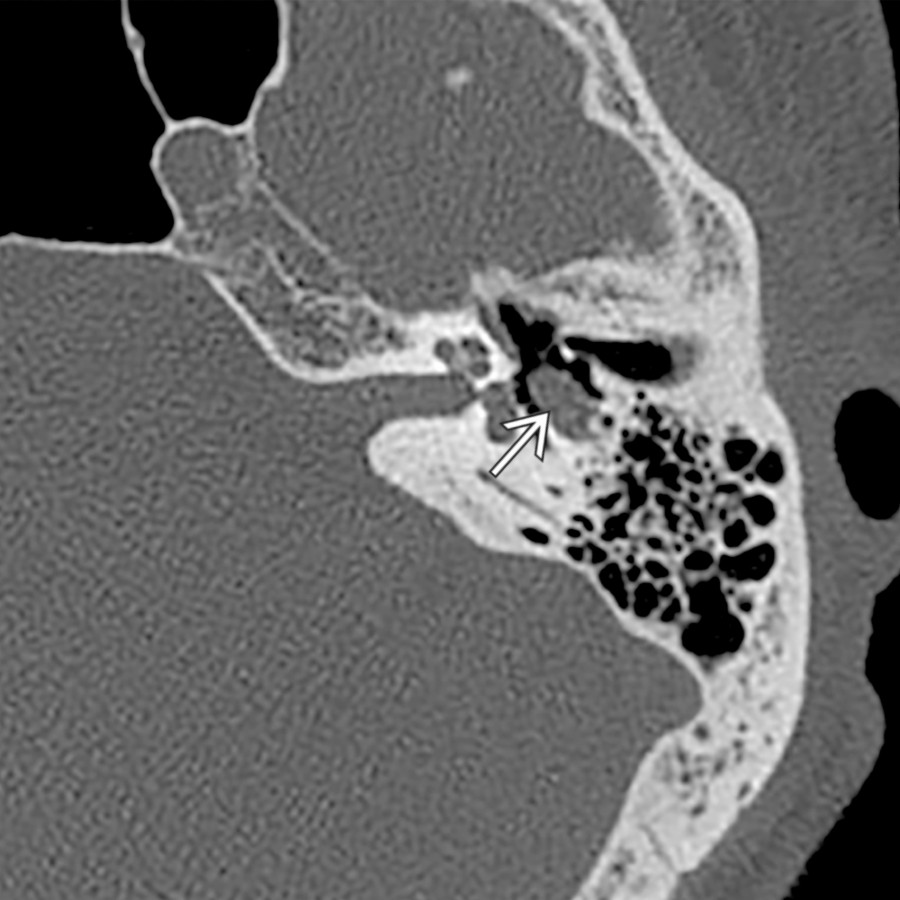 Axial temporal bone CT in a patient with progressive partial left facial nerve paralysis associated with episodes of ipsilateral otalgia shows localized expansile enlargement of the tympanic segment of the facial nerve
. The patient was initially treated with steroids for presumed Bell palsy, but subsequently underwent imaging when he did not respond.