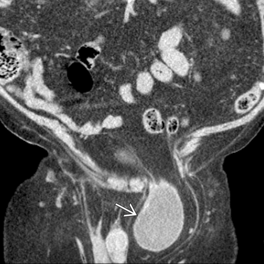 Coronal NECT demonstrates a sliding inguinal hernia containing a portion of the bladder
. Sliding inguinal hernias contain portions of partially retroperitoneal structures, such as the bladder, and care must be taken at surgery to avoid damage to these structures or their supplying vessels.