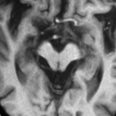Axial T1WI in the same patient shows concave appearance of lateral surface of midbrain
(morning glory or Mickey Mouse sign) due to atrophy.
