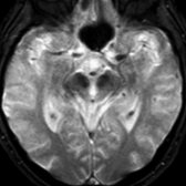 Axial T2* GRE MR in patient with PSP shows no evidence for abnormal iron accumulation in the midbrain, which helps to distinguish PSP from PD.