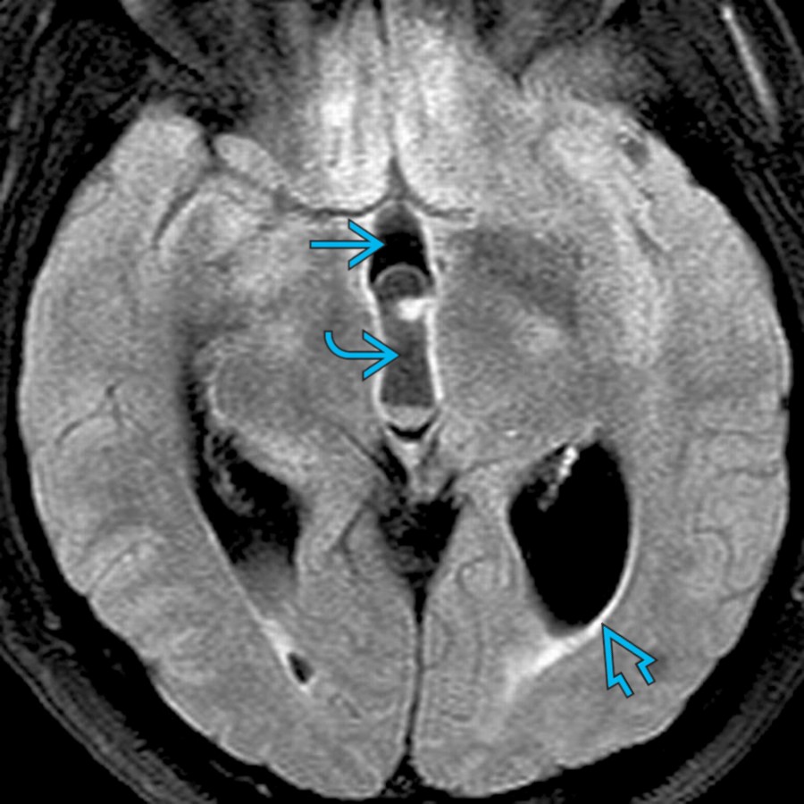 Axial FLAIR MR demonstrates an intraventricular neurocysticercosis
in the posterior 3rd ventricle with dilatation of the anterior 1/3
and lateral ventricles. Note the mild periventricular interstitial edema
.