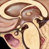 Sagittal graphic shows ectopia of the posterior pituitary gland
located at the distal end of a truncated pituitary stalk along the median eminence of the hypothalamus. The sella turcica and adenohypophysis
are both small.